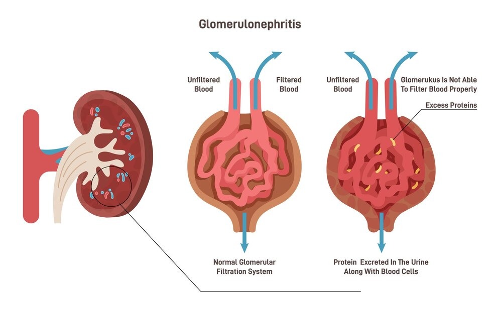 Glomerulonephritis Treatment in Gurugram 